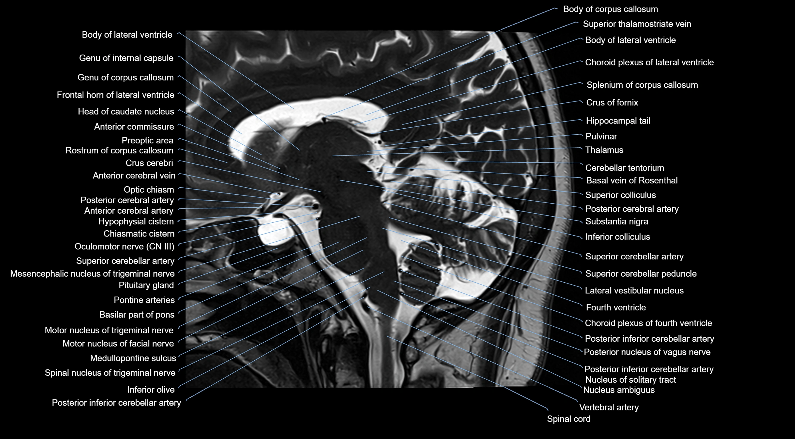 MRI brainstem & basal ganglia anatomy labelled  3T MRI images -img-10001-00021.webp